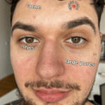 Acne Scars