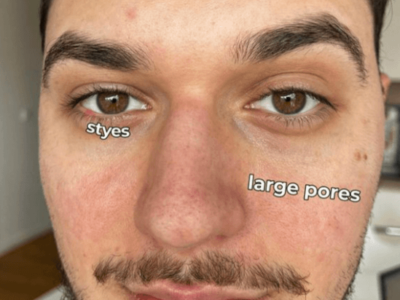 Acne Scars