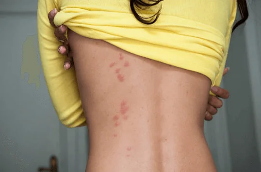 Bed Bug Bites