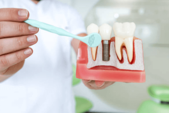 Clearchoice Dental Implants