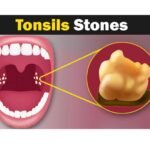 Tonsil Stone