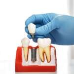 Dental Implant Centers in Houston