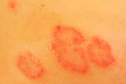 Nummular Eczema Diet Guide