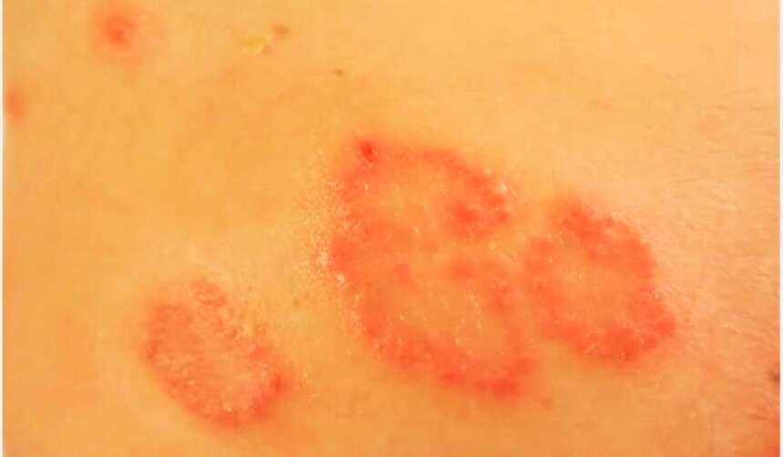 Nummular Eczema Diet Guide