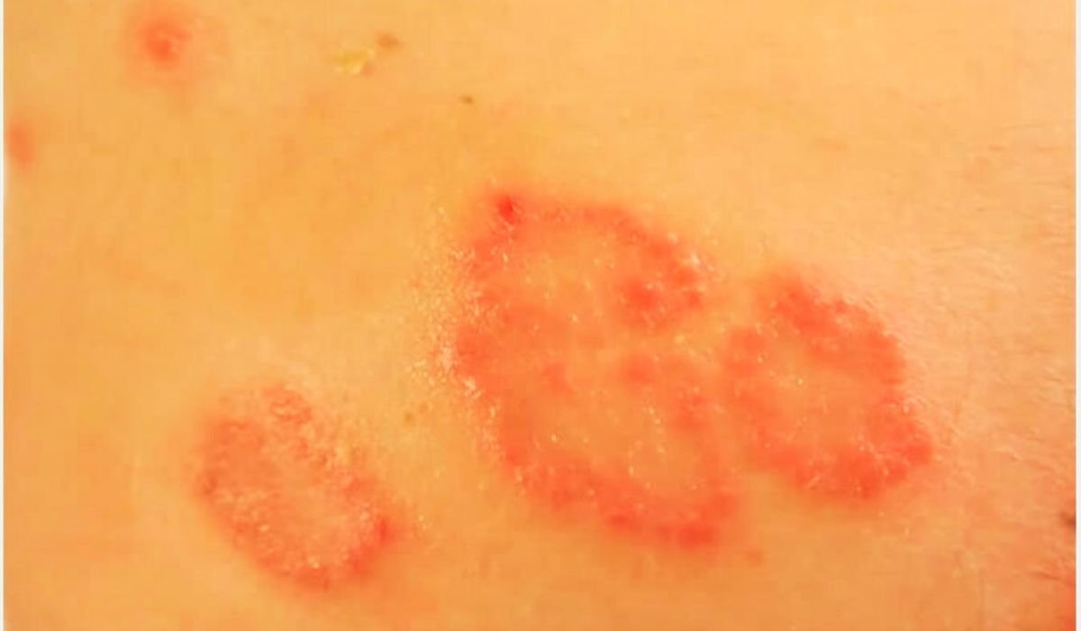 Nummular Eczema Diet Guide: Foods That Reduce Inflammation and Irritation