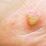 Nummular Eczema Treatment Options