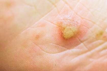 Nummular Eczema Treatment Options