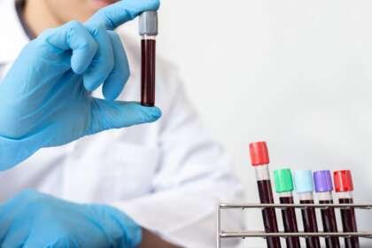 Blood Test Could Revolutionize Sarcoidosis Diagnosis, Study Finds