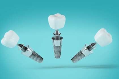 5 Best Dental Implant Providers in Raleigh, NC
