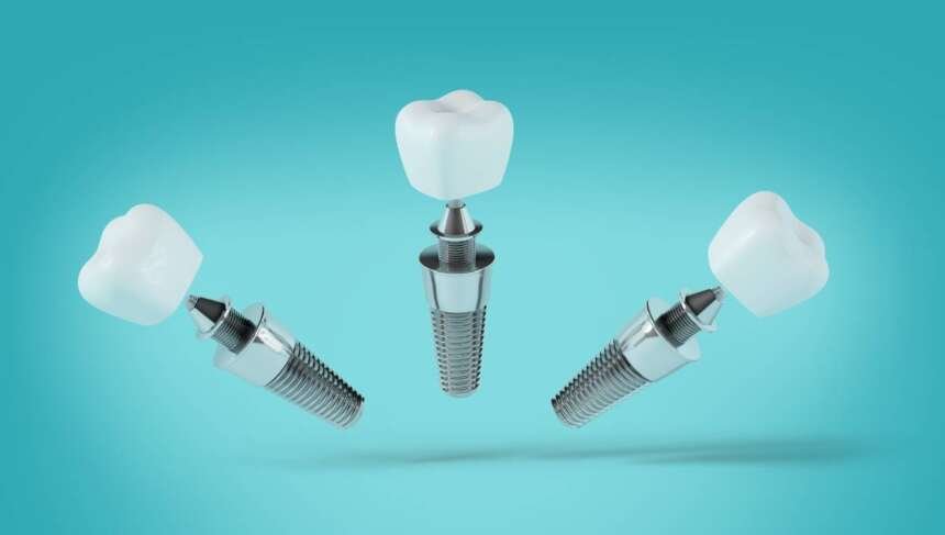 5 Best Dental Implant Providers in Raleigh, NC