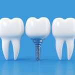 Best Dental Implant Providers in Orlando