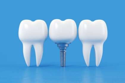 Best Dental Implant Providers in Orlando