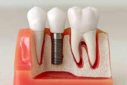 Best Dental Implant Providers in St. Louis